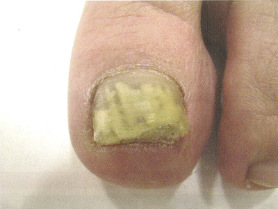 爪白癬（DLSO型）