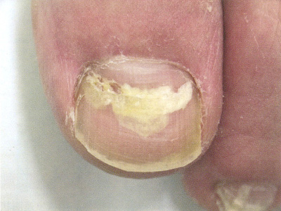 爪白癬（PSO型）