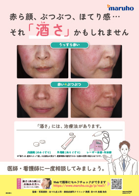 (疾患啓発資材)酒さ院内掲示ポスター