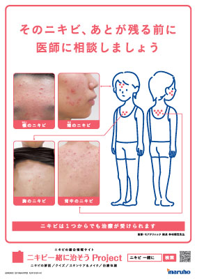 （ポスター）ざ瘡疾患啓発ポスターA4サイズ